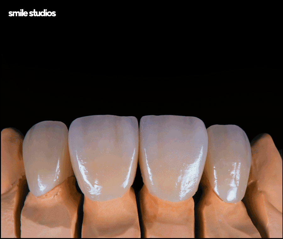 앞니 벌어짐 교정? 라미네이트? 케이스별 추천 방법 관련 이미지 10