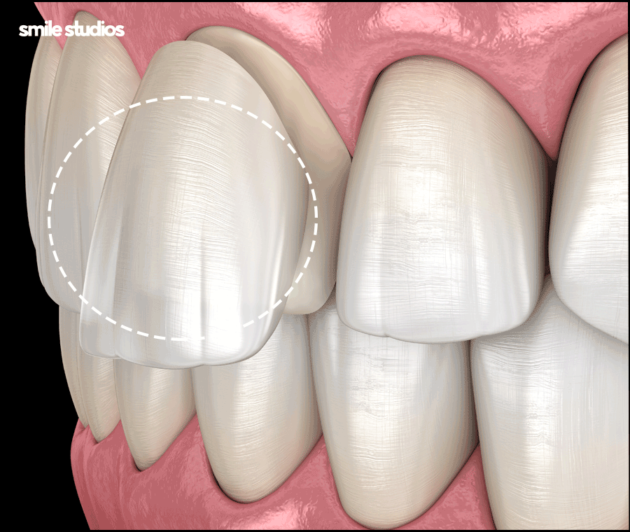 앞니 블랙트라이앵글 보완을 위한 라미네이트 효과 관련 이미지 7