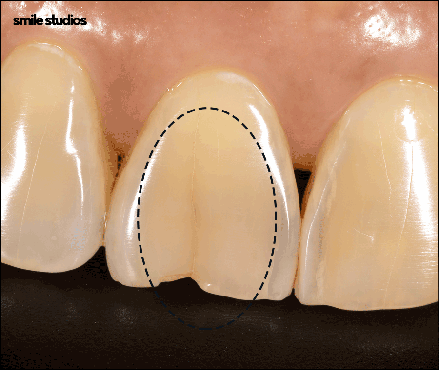 앞니깨짐 치료, 라미네이트 수복 여부, 효과 관련 이미지 2