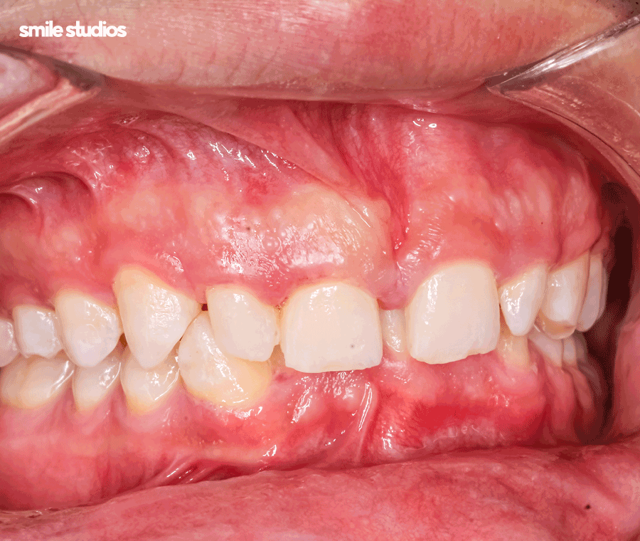 강남 논현 치과 투명 치아교정 시작 전 확인사항 관련 이미지 3