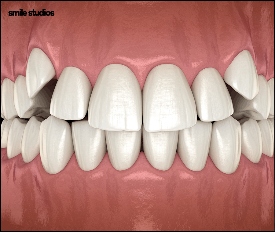 논현동 치과 인비절라인 투명교정 효과, 장/단점 관련 이미지 2