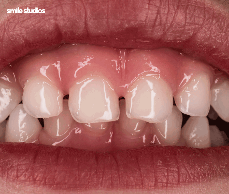 이빨사이벌어짐 부분 교정, 라미네이트 선택 Tip 관련 이미지 5