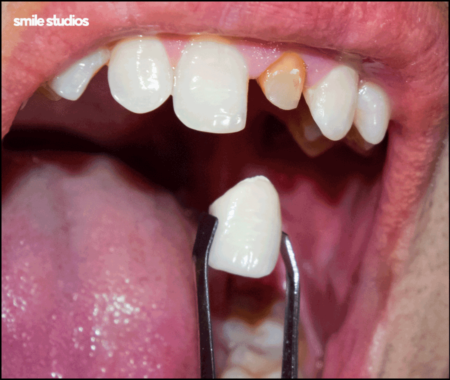 역삼역 치과, 치아 파임 증상 라미네이트 효과는? 관련 이미지 3