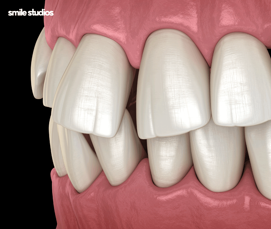 부정교합 교정기(투명) 종류 및 특징 알아보기 관련 이미지 3