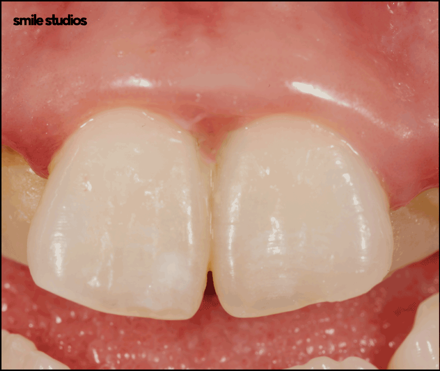 토끼이빨교정, 올바른 정렬을 위한 효과적인 방법은? 관련 이미지 2