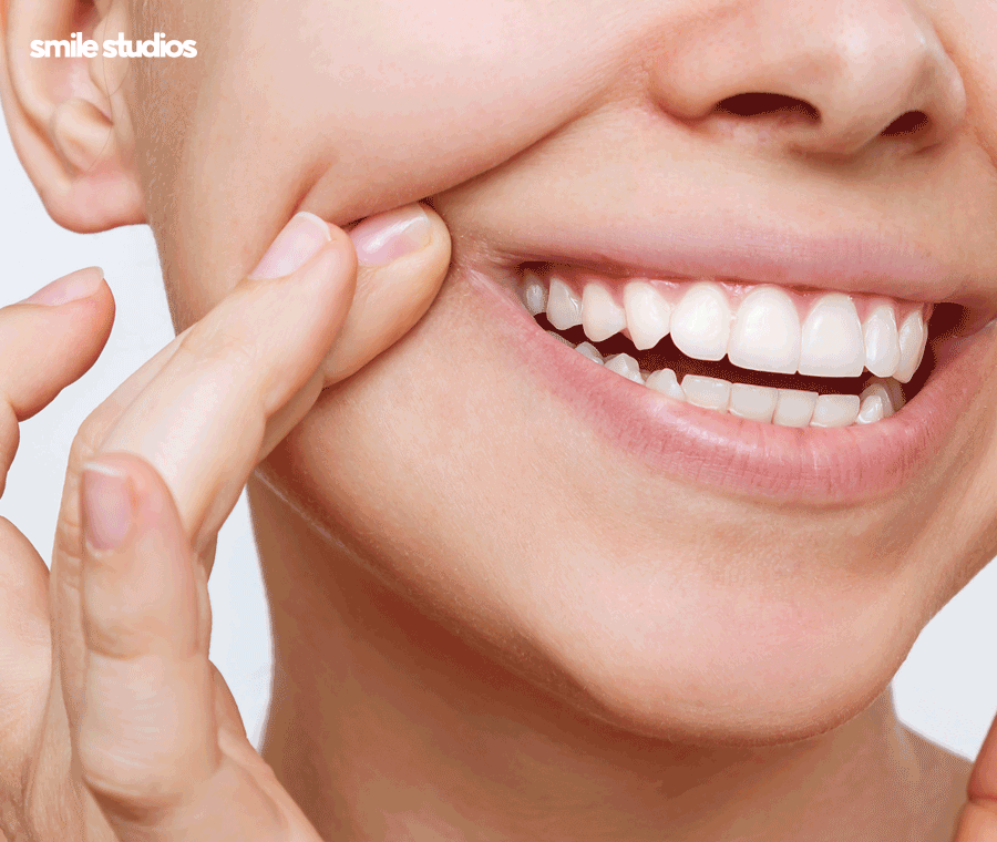 연예인 라미네이트 자연스러운 미소의 비밀은? 관련 이미지 2