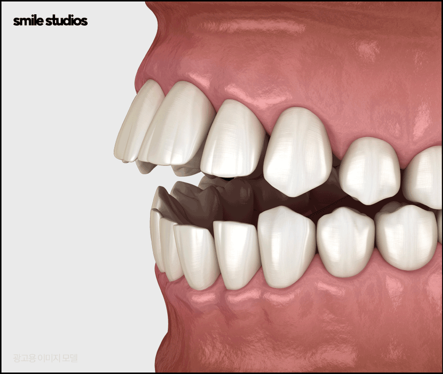 강남치과의원, 나노라이너 특징 및 효과 알아보기 관련 이미지 2