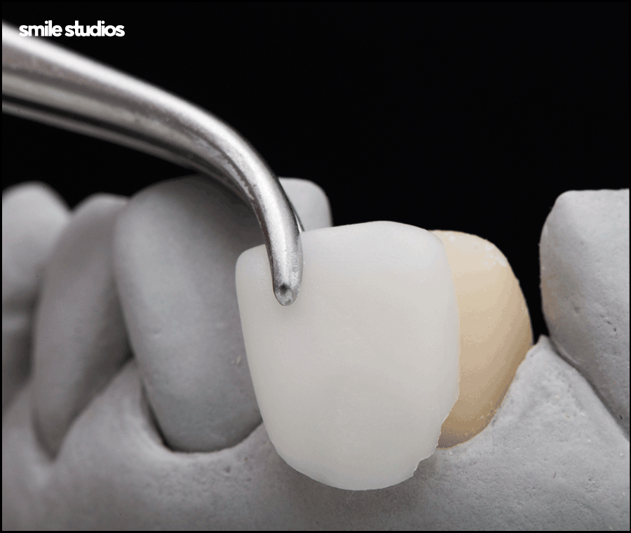 라미네이트 재시술 필요한 케이스, 주의사항 정리 관련 이미지 5