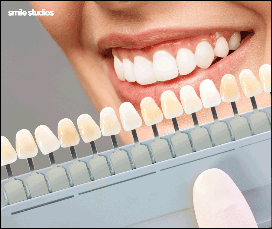 치아무삭제라미네이트 사실과 오해 알아보기 관련 이미지 8