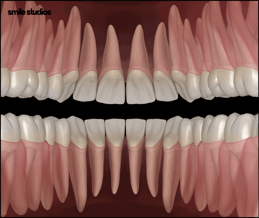 강남치과의원, 나노라이너 특징 및 효과 알아보기 관련 이미지 3