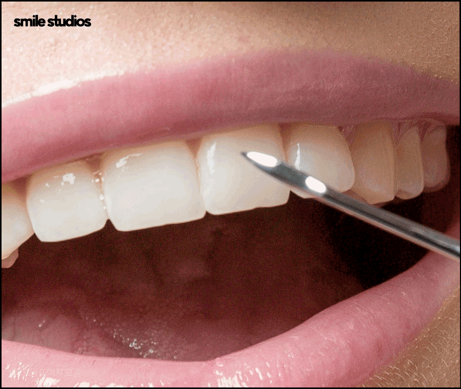 최소삭제 라미네이트 성공하려면 체크할 점 관련 이미지 5