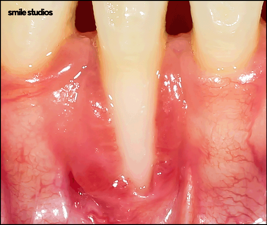 치경부마모증, 주저앉은 잇몸? 원인과 해결 방법 관련 이미지 4