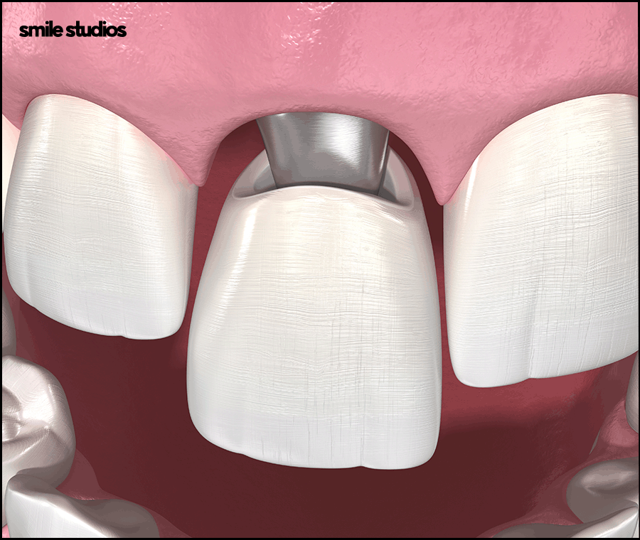 도산대로치과 앞니 라미네이트 크라운 차이점 관련 이미지 9