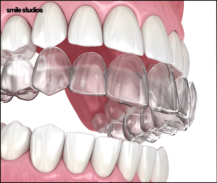 인비절라인 통증이 적은 결정적인 이유 알아보기 관련 이미지 3