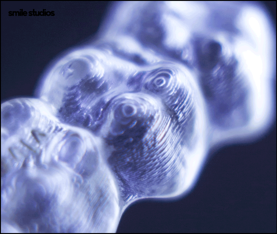 돌출입 인비절라인 기간, 과정, 개선 효과 관련 이미지 9