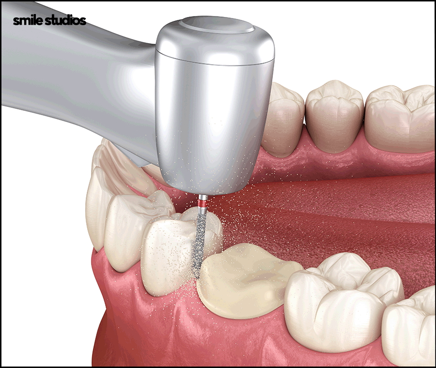 신논현역치과, 라미네이트 시술 전 꼭 확인할 핵심 2가지 관련 이미지 5