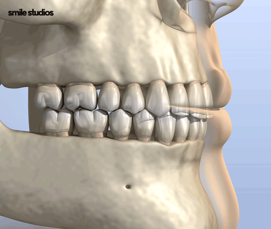 돌출입교정가격 기준 및 효과, 방법 파헤치기 관련 이미지 3