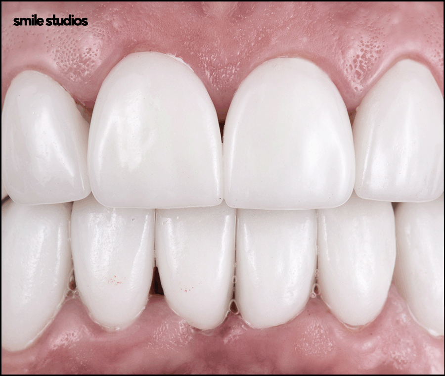 치아무삭제라미네이트 사실과 오해 알아보기 관련 이미지 2