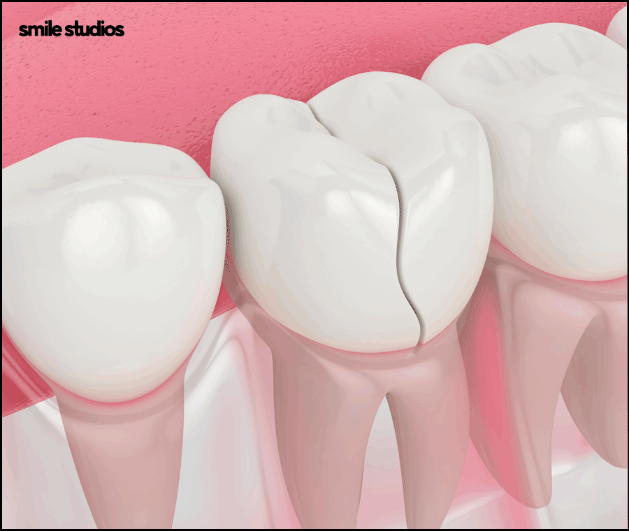 앞니깨짐 치료, 라미네이트 수복 여부, 효과 관련 이미지 4