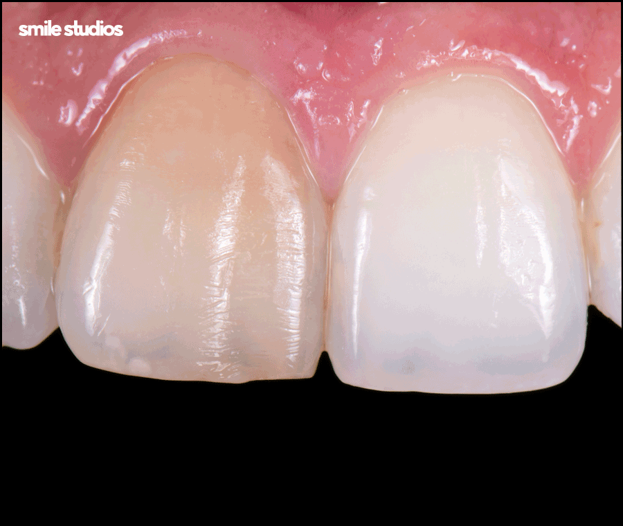 치아반점치 흰얼룩 발생하는 원인, 회복 방법 관련 이미지 3