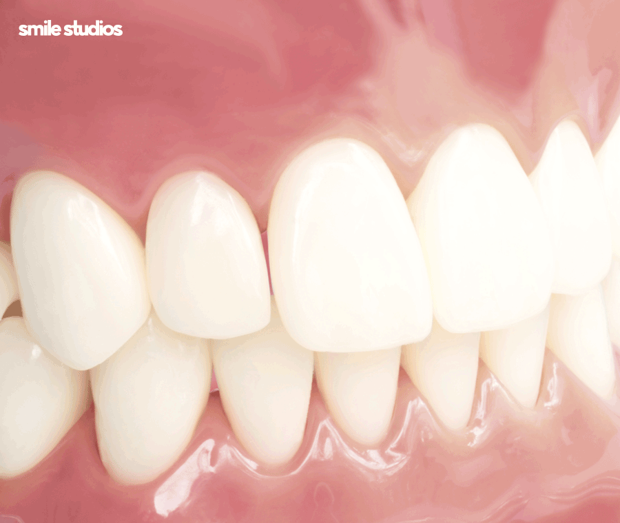 연예인 라미네이트 자연스러운 미소의 비밀은? 관련 이미지 7