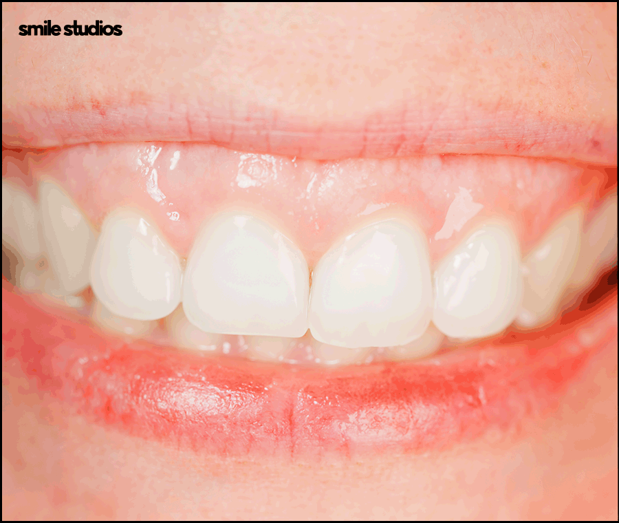 거미스마일 앞니 잇몸 과노출, 원인 및 보완 방법 관련 이미지 2