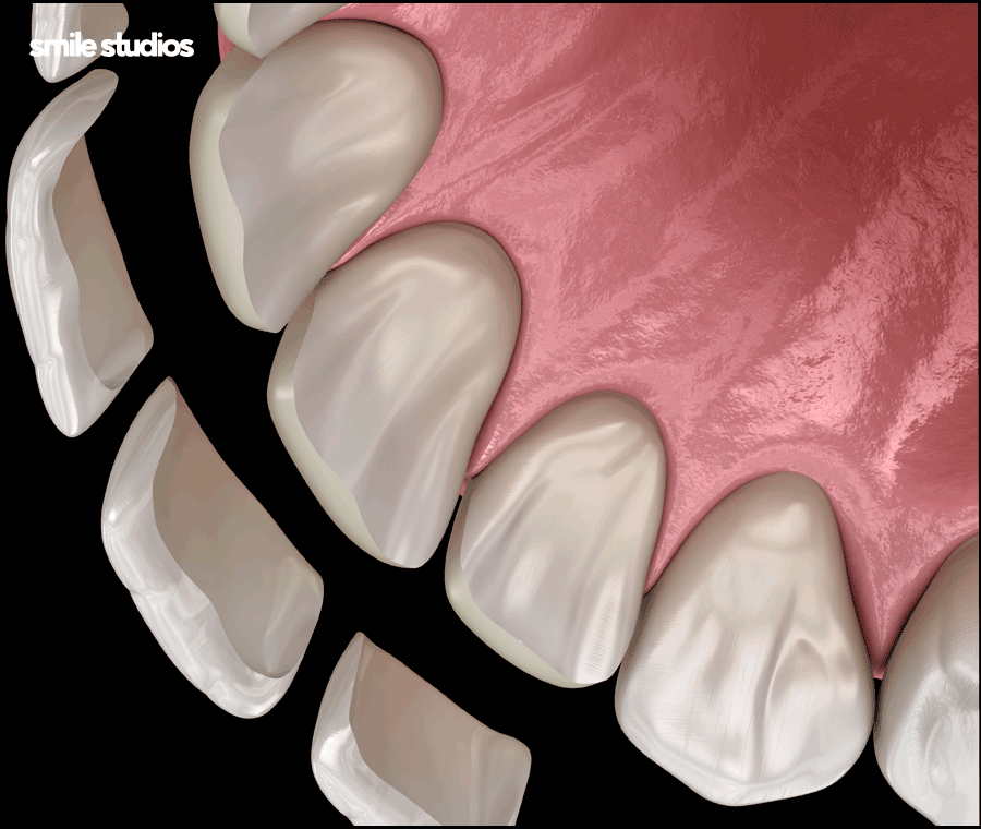 앞니 크랙 금간 치아, 빠른 수복 방법 알아보기 관련 이미지 7