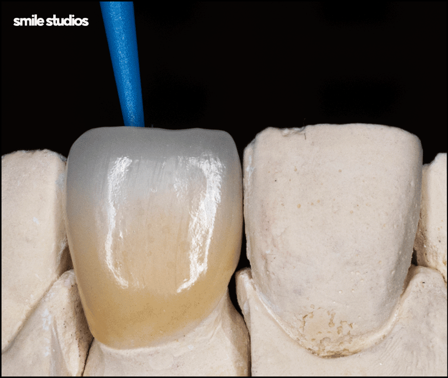 강남역 치과 라미네이트 섬세한 접근의 중요성 관련 이미지 5