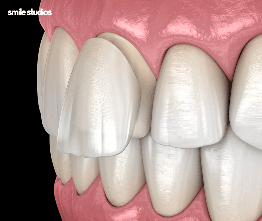 치아사이 벌어짐 가지런한 앞니 만드는 Tip 관련 이미지 7