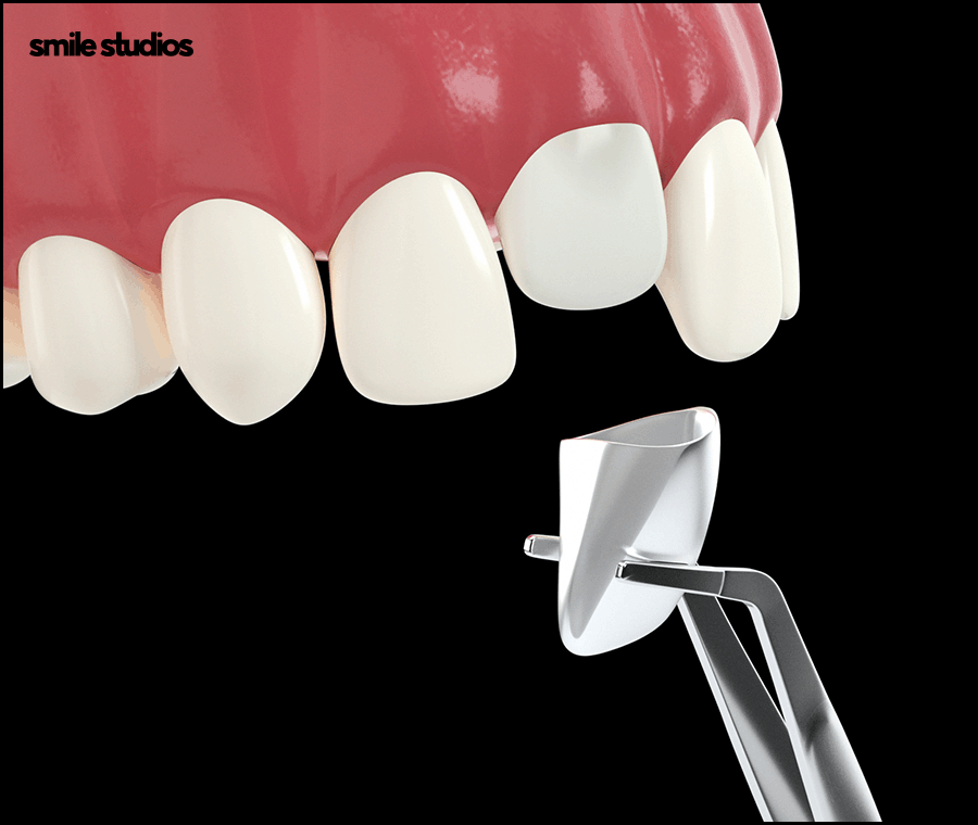 강남라미네이트 기대 효과, 원리, 유지기간 관련 이미지 9