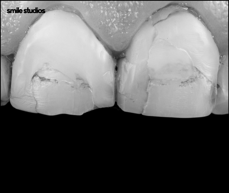 앞니 크랙 금간 치아, 빠른 수복 방법 알아보기 관련 이미지 2