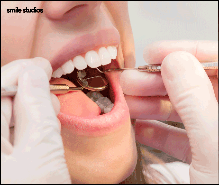 반포동 치과 돌출입 교정, 인비절라인 효과는? 관련 이미지 10