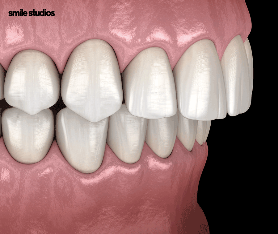 뻐드렁니 교정 성공적인 결과를 위한 key 확인 관련 이미지 3