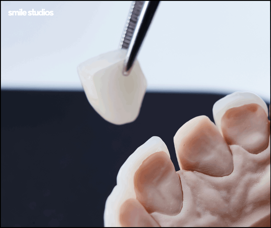 김영경 원장이 전하는 무삭제 라미네이트 A to Z 관련 이미지 7