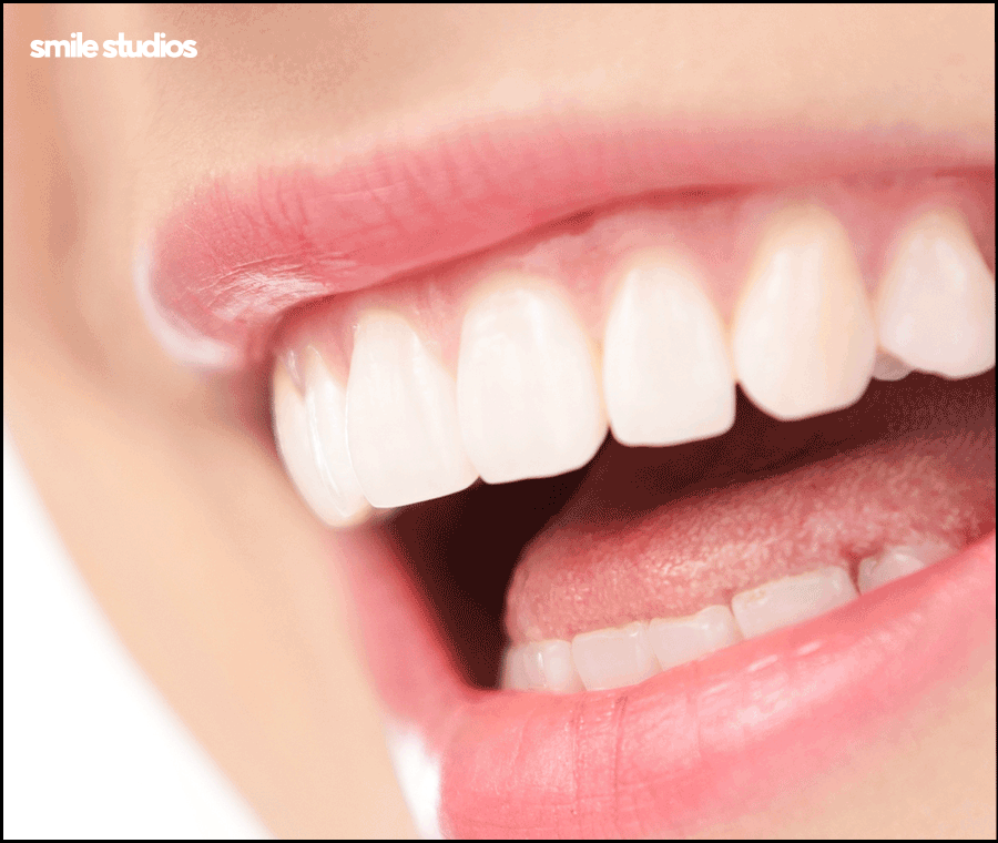 앞니 블랙트라이앵글 보완을 위한 라미네이트 효과 관련 이미지 9