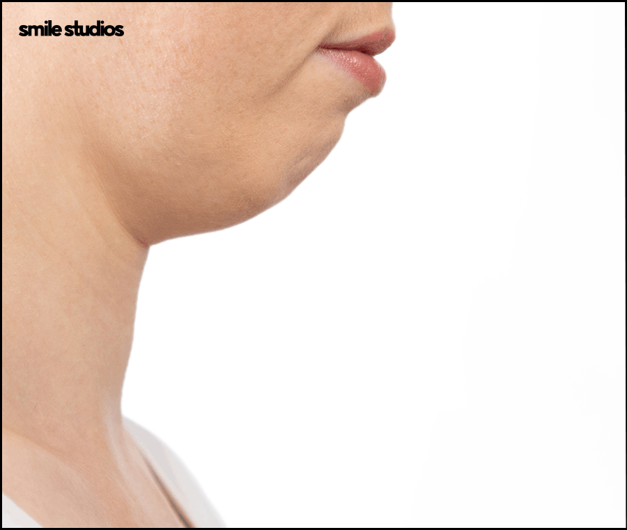 What Are the Key Points That Affect the Success of Receding-Chin Correction? image 2