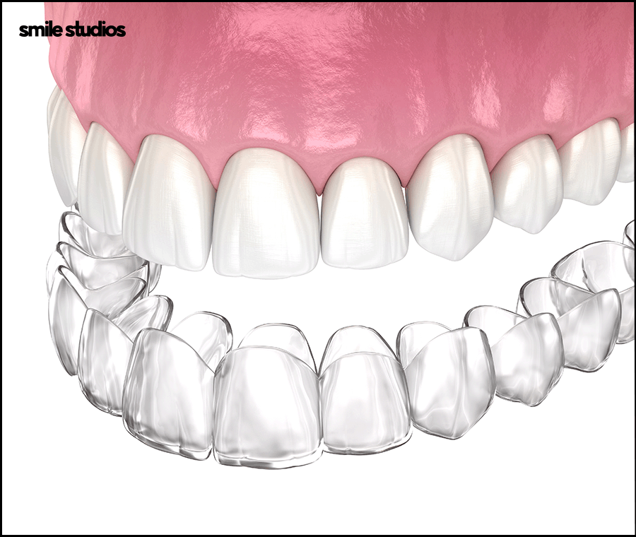 강남논현동치과 인비절라인 과정 및 개선 효과는? 관련 이미지 2