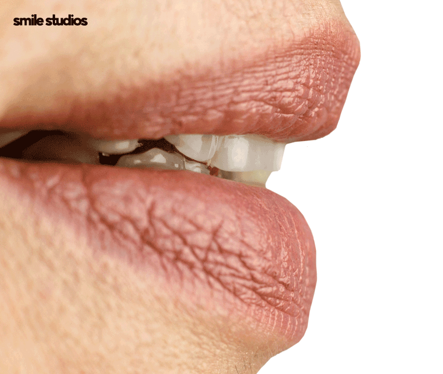 돌출입교정가격 기준 및 효과, 방법 파헤치기 관련 이미지 7