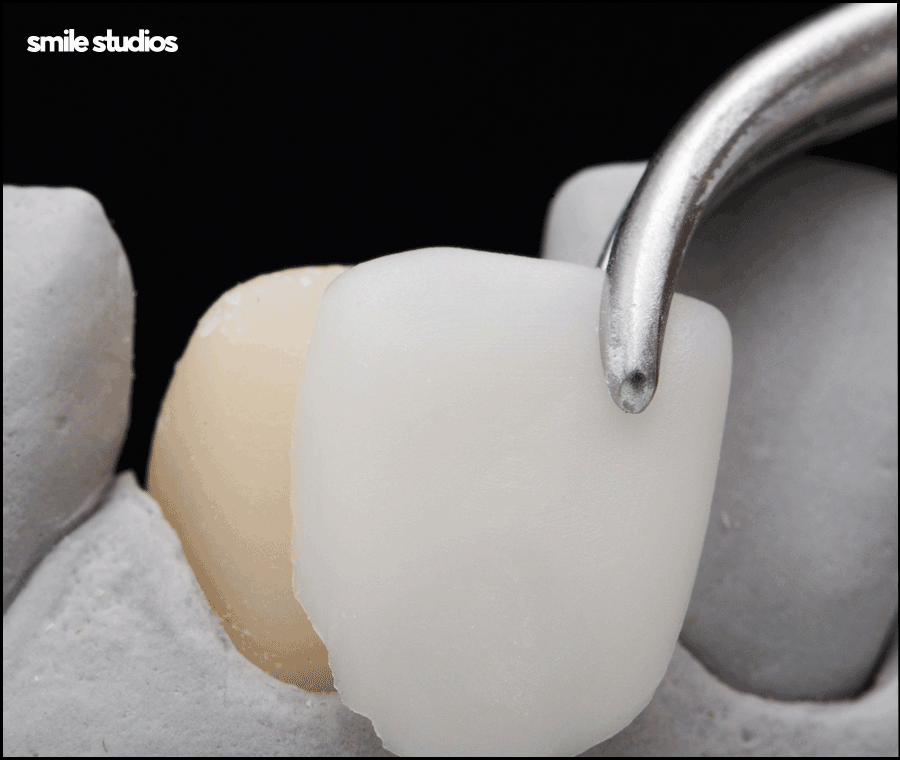 압구정로데오치과 라미네이트 하기 전 체크할 사항 관련 이미지 7