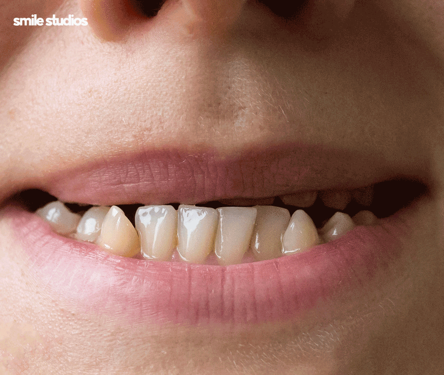 50대 치아교정 늦지 않은 이유, 방법, 효과 정리 관련 이미지 3