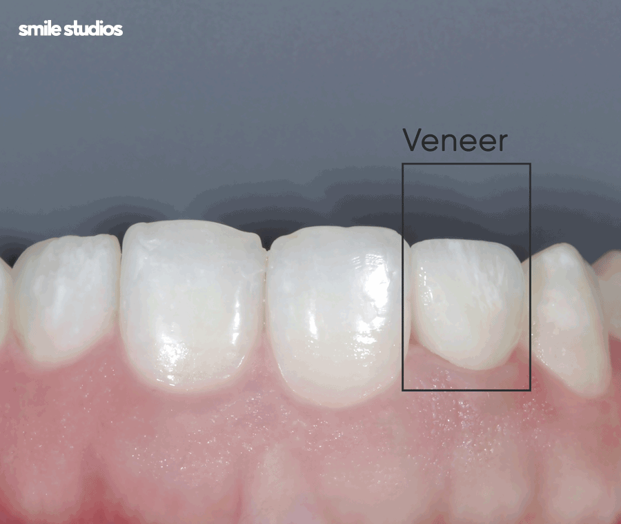 학동역치과 라미네이트 고민된다면 사전에 확인할 점 관련 이미지 8