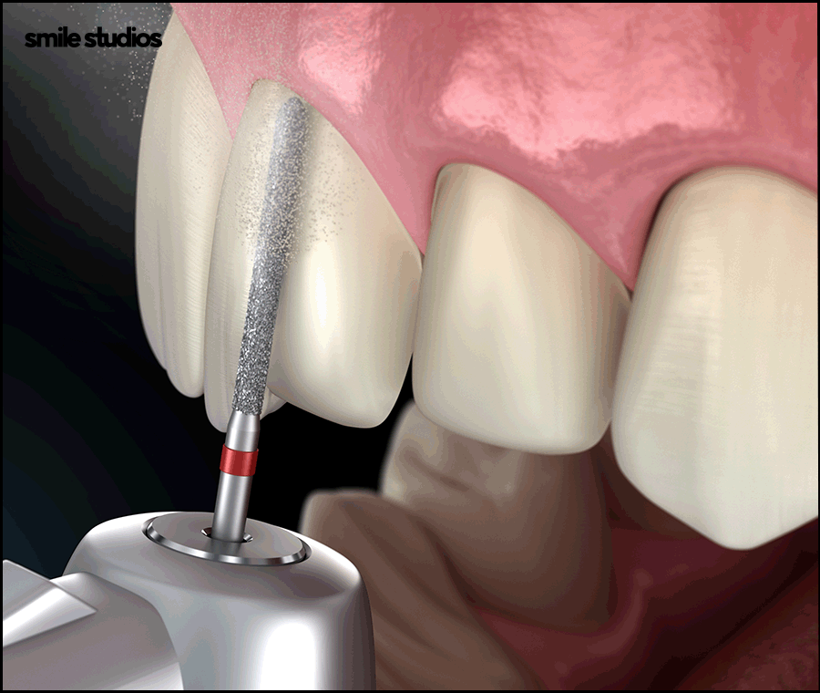 치과라미네이트 고른 치아 만들 때 핵심은? 관련 이미지 6