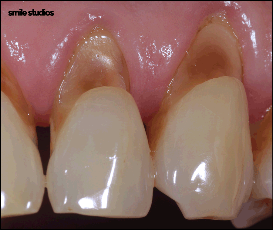 치경부마모증, 주저앉은 잇몸? 원인과 해결 방법 관련 이미지 3