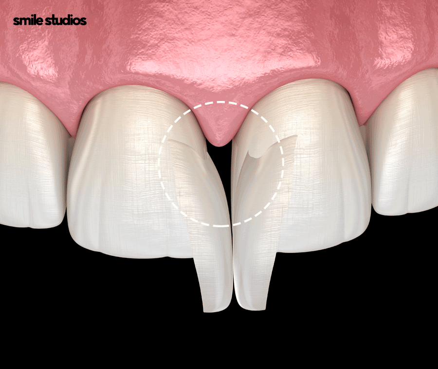 치아사이 벌어짐 가지런한 앞니 만드는 Tip 관련 이미지 4