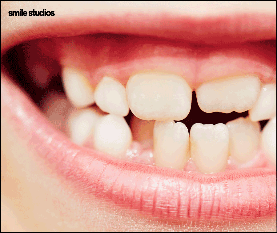 왜소치라미네이트 심미성 개선 효과, 필요성 관련 이미지 2