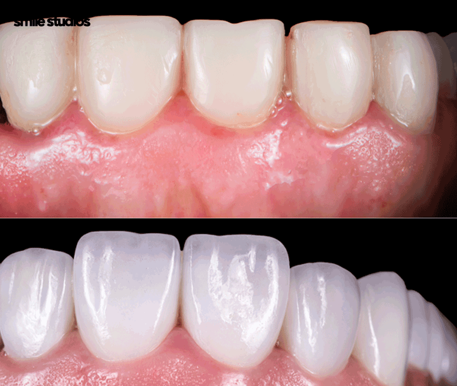 서초 신논현 치과 무삭제 라미네이트 특징, 장단점 관련 이미지 2