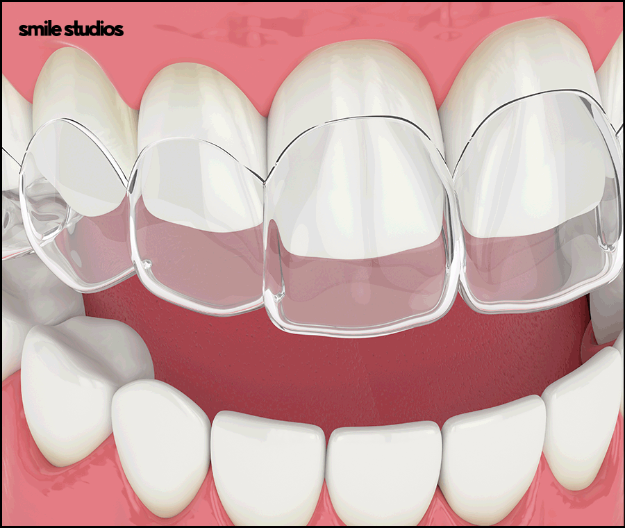 반포동 치과 돌출입 교정, 인비절라인 효과는? 관련 이미지 7