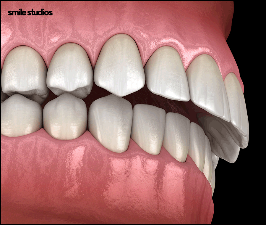 강남논현동치과 인비절라인 과정 및 개선 효과는? 관련 이미지 5