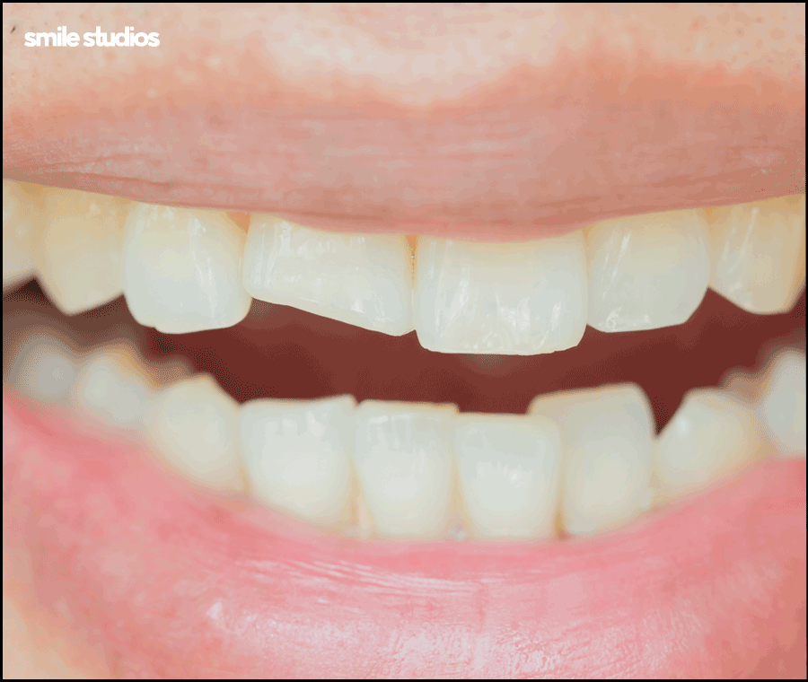 깨진이빨(앞니깨짐) 라미네이트 시술 효과는? 관련 이미지 5