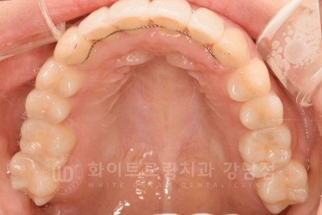 강남 덧니 비발치교정 / 임플란트와 치아교정 동시 진행 case 리뷰. 관련 이미지 21